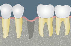 cartoon depiction of oral bone graft