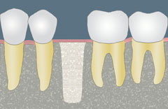 cartoon graphic of second step of oral bone graft