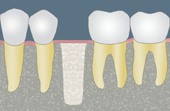 Bone Graft, Sinus Lift in Austin, TX | Midtown Oral 