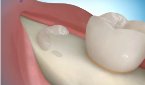 3d graphic of impacted tooth