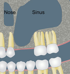 Cartoon depiction of sinus graft - initial