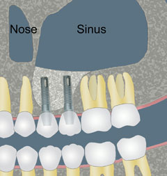 Cartoon depiction of sinus graft - step 2